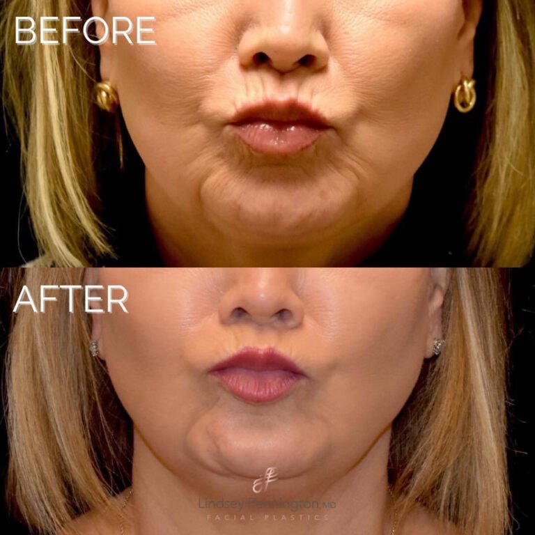 Conservative-lip-filler-and-Botox-combo_img1