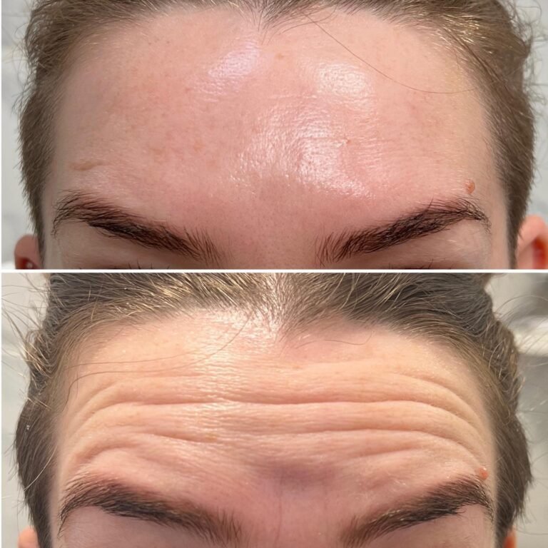 Wrinkle-Reduction-Success-Ascot-Windsor-Bracknell